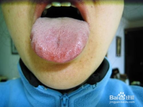 小孩积食咳嗽怎么办？小孩舌苔厚白是怎么回事