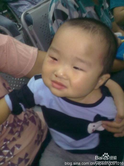 长了麦粒肿,要不要挤破了事呢