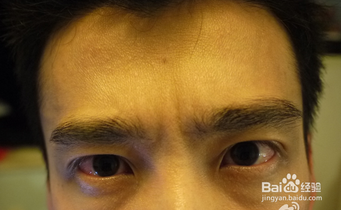 得了红眼病怎么办