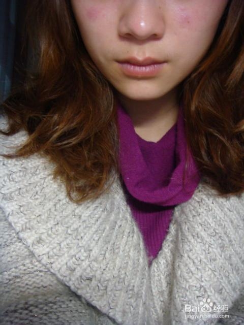 如果青春期长了青春痘怎么办