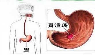 胃溃疡患病的原因与什么有关