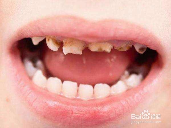 <b>2岁儿童门牙靠近牙龈处有龋齿怎么办</b>