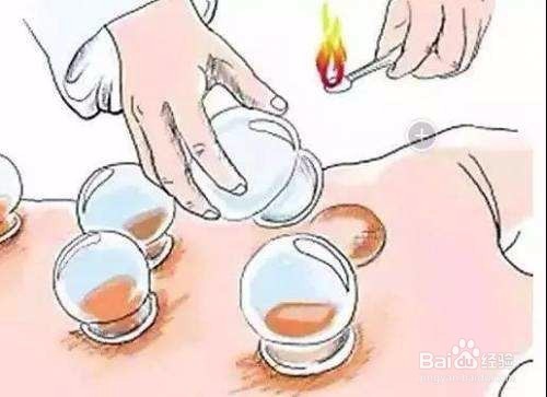 拔罐有什么讲究吗？