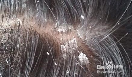 百度经验--如何去除头皮屑的困扰