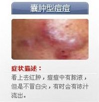 痘痘的种类有哪些