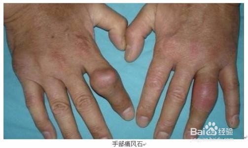 痛风治疗小知识