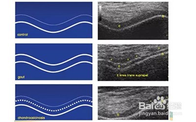 如何早期发现痛风