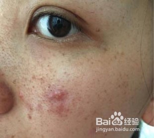 教你如何调理暗疮性皮肤