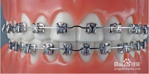 整完牙为什么要带保持器？