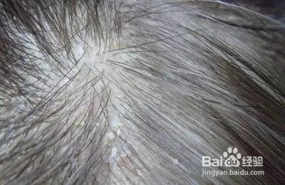 脱发后新头发为什么长不出来？