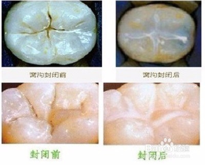妈妈该如何帮助宝宝预防蛀牙？