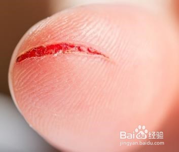 做饭切到手指怎么办