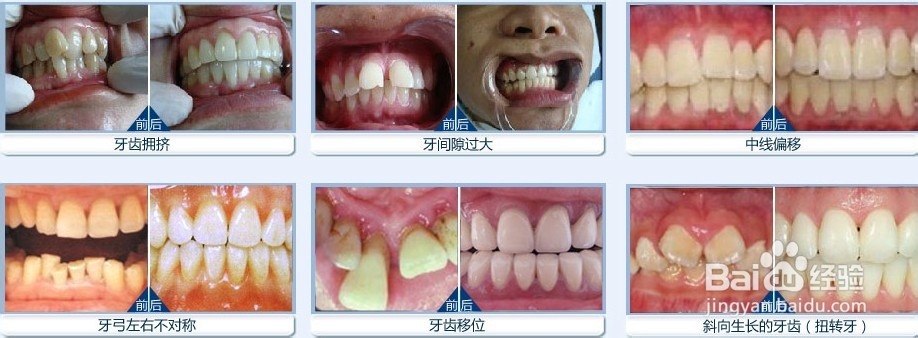 牙齿矫正的方法有哪些