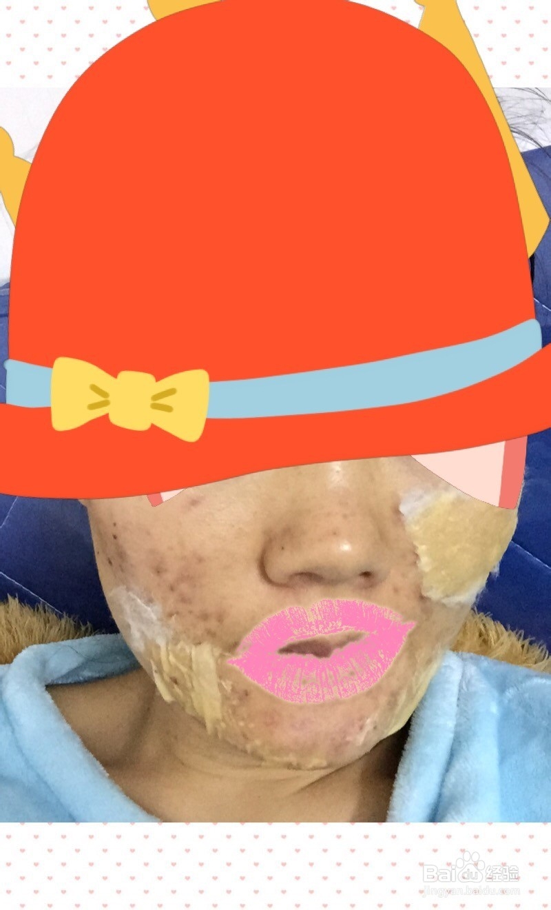 我的抗痘历程