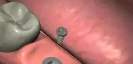 种植牙的过程是怎样的