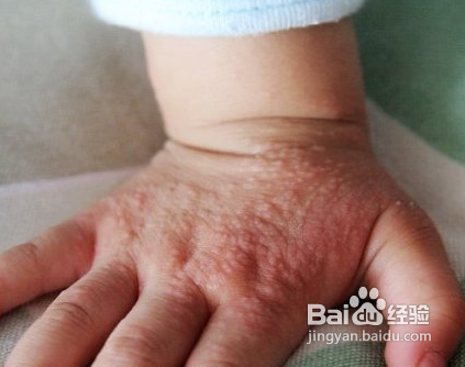 婴儿长湿疹怎么办