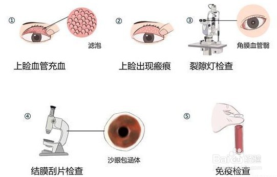 怎么检查是否得了沙眼
