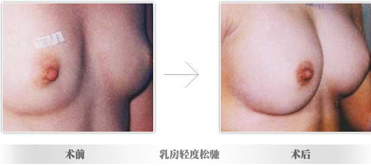 韩式无痕隆胸有哪些优势