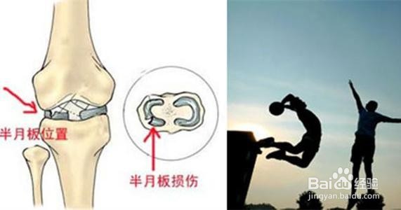 半月板损伤的症状都有什么