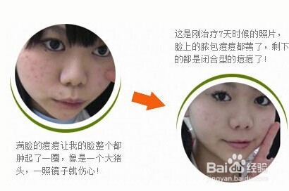 怎么样消除青春痘
