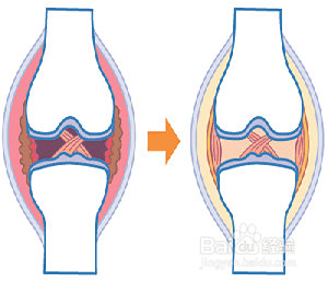 膝盖疼是怎么回事分情况护理膝关节