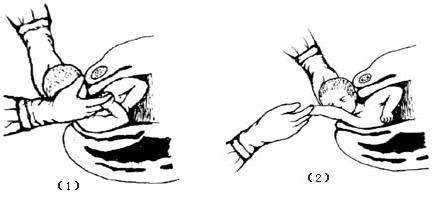 肩难产的七步处理方法