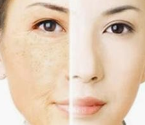 快速有效的祛斑方法