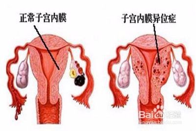 切除子宫可以根治子宫内膜异位症吗 百度经验