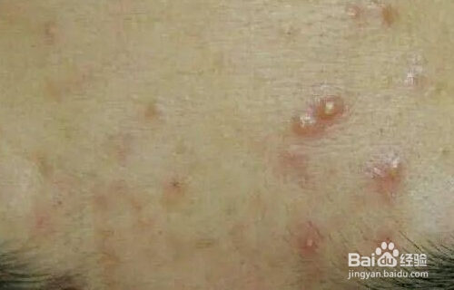 闭口粉刺如何快速消掉