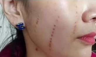 做完超声刀后如何补水？术后要敷一个月面膜？