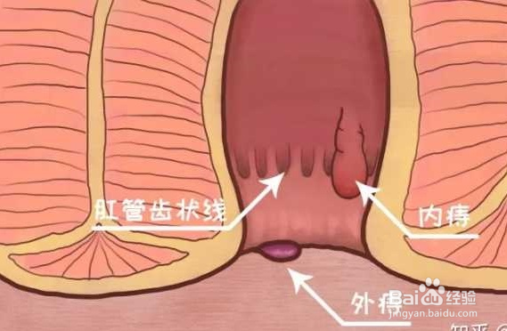 痔疮常见的分型有哪几种