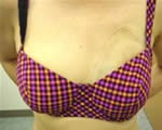人工乳房定制全过程!