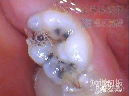 孩子六龄齿窝沟封闭有必要吗?九成父母都不知道