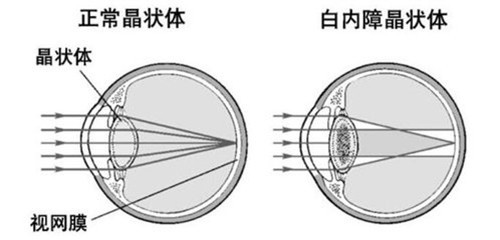中老年人的白内障手术什么时候做最合适？