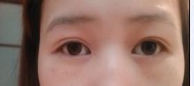 眼睛一单一双怎么办