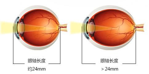 孩子近视了有办法恢复吗
