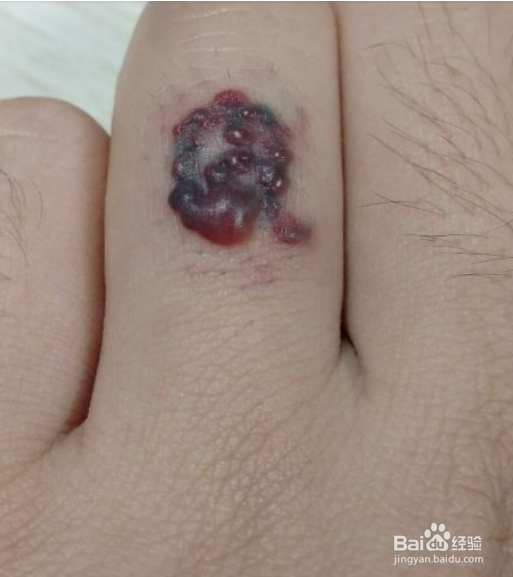 当兵体检手上有纹身怎么办