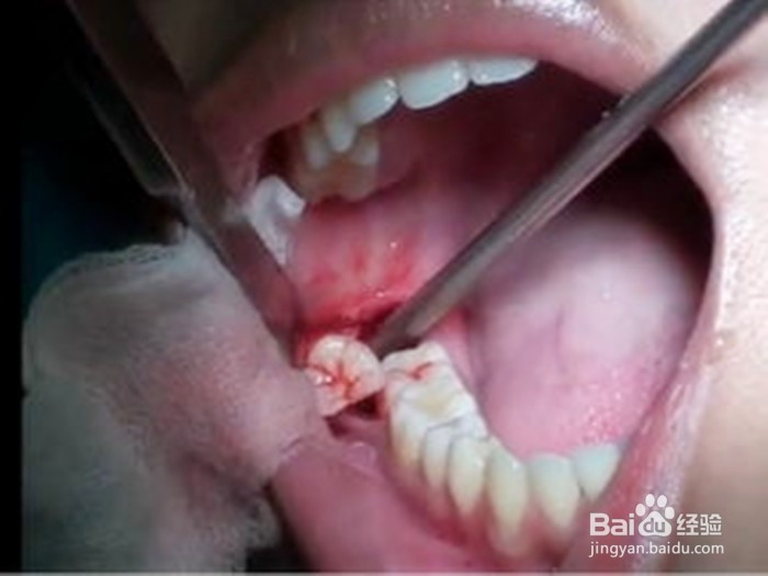 长智齿好痛怎么办