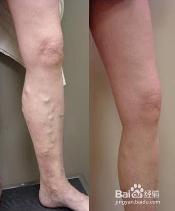 静脉曲张简介、预防、治疗