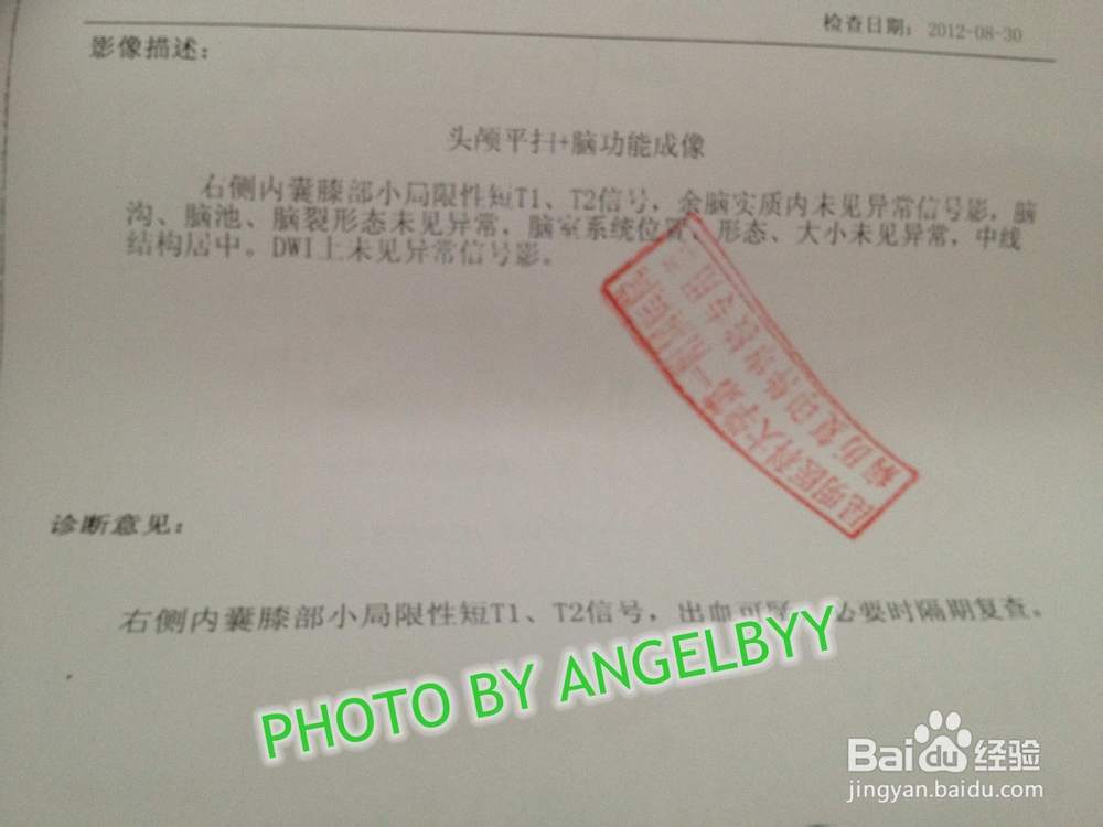 家有早产儿之颅脑出血