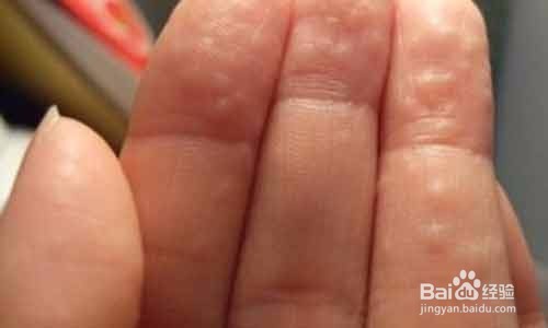 手上出现密密麻麻的小水泡怎么办