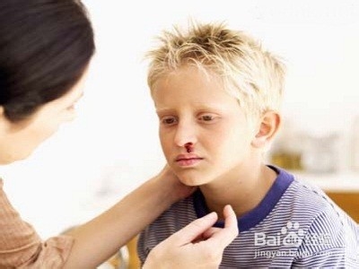 鼻出血紧急处理时应注意什么？