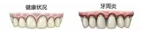 吃东西塞牙可不是小问题