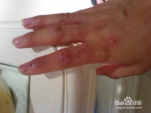 狗咬了肿起来了怎么办