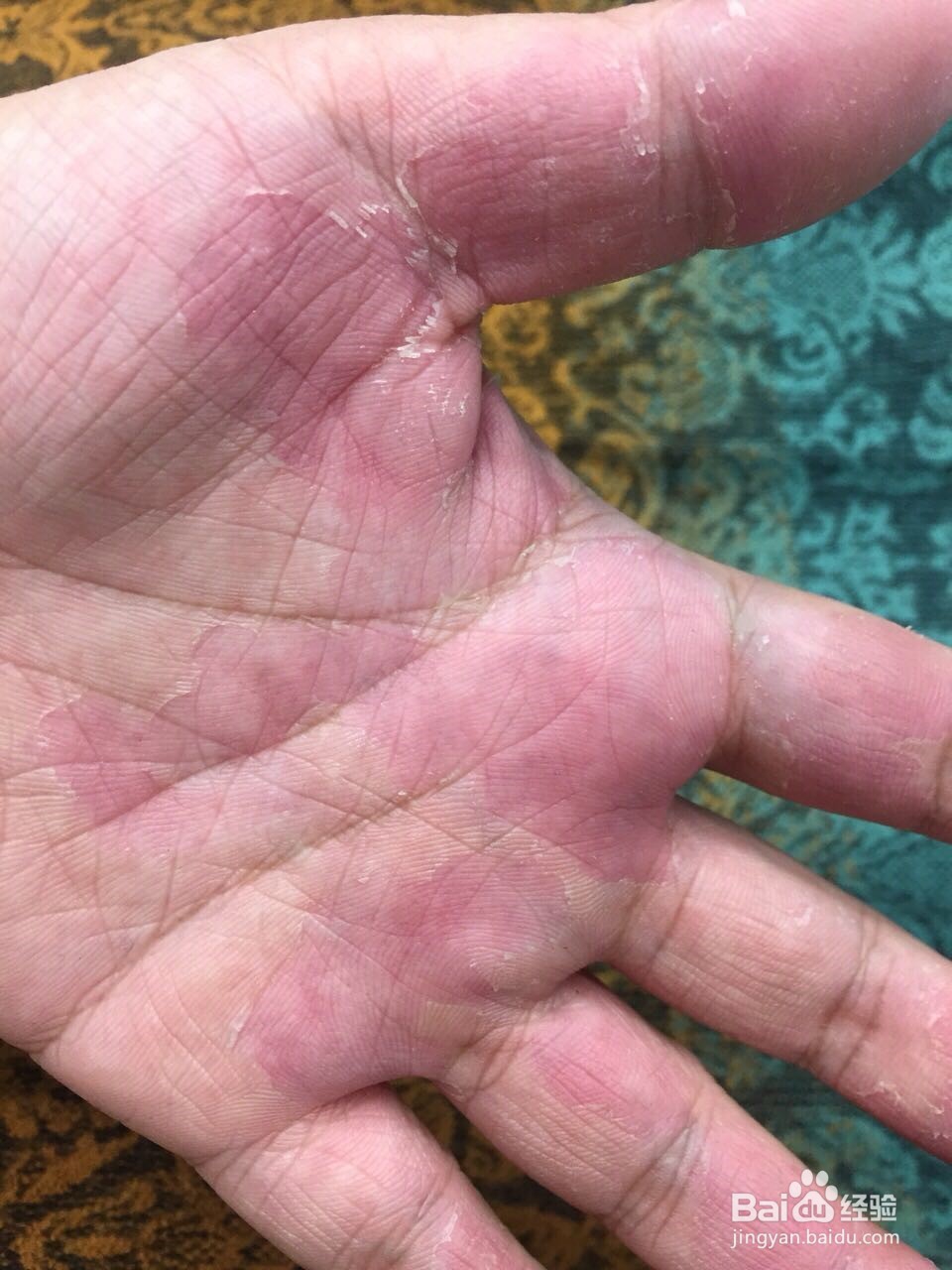 洗洁精损伤皮肤的救助