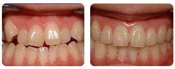 导致牙齿不齐的原因