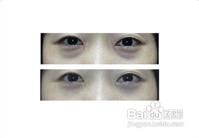 去除不同眼袋的方法，你属于哪一种呢？