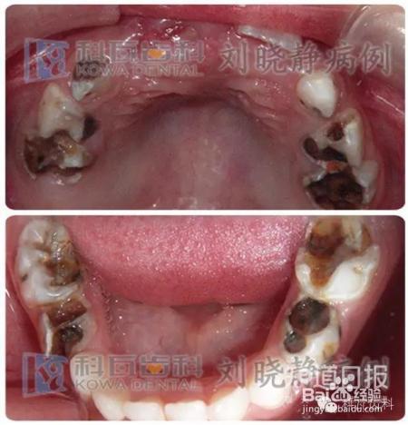 孩子六龄齿窝沟封闭有必要吗?九成父母都不知道