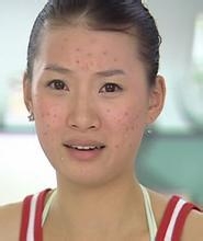 如何治疗痤疮吗