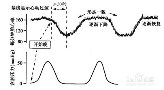 胎心监护加速减速是什么为什么胎心监护曲线平